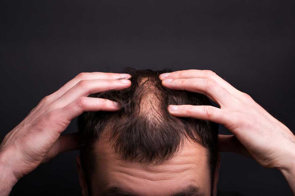 فیناستراید برای ریزش مو مردانه