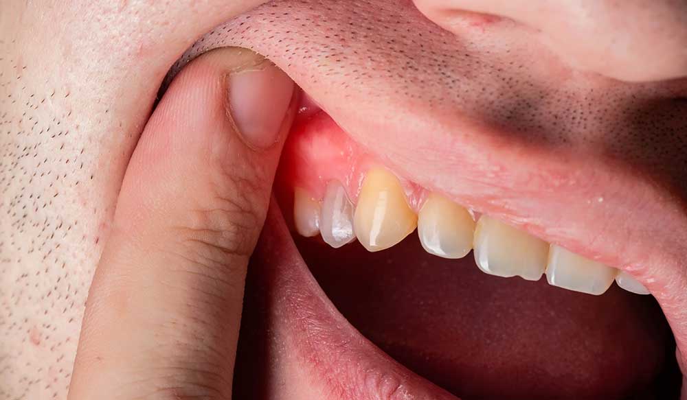 علائم آبسه دندان