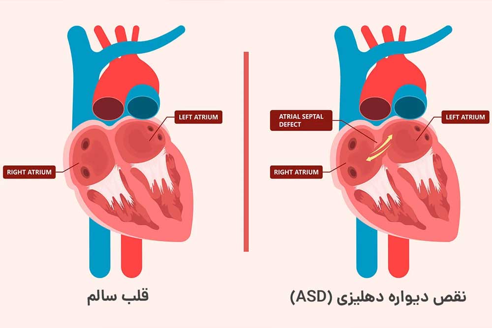 نقص دیواره دهلیزی (ASD)